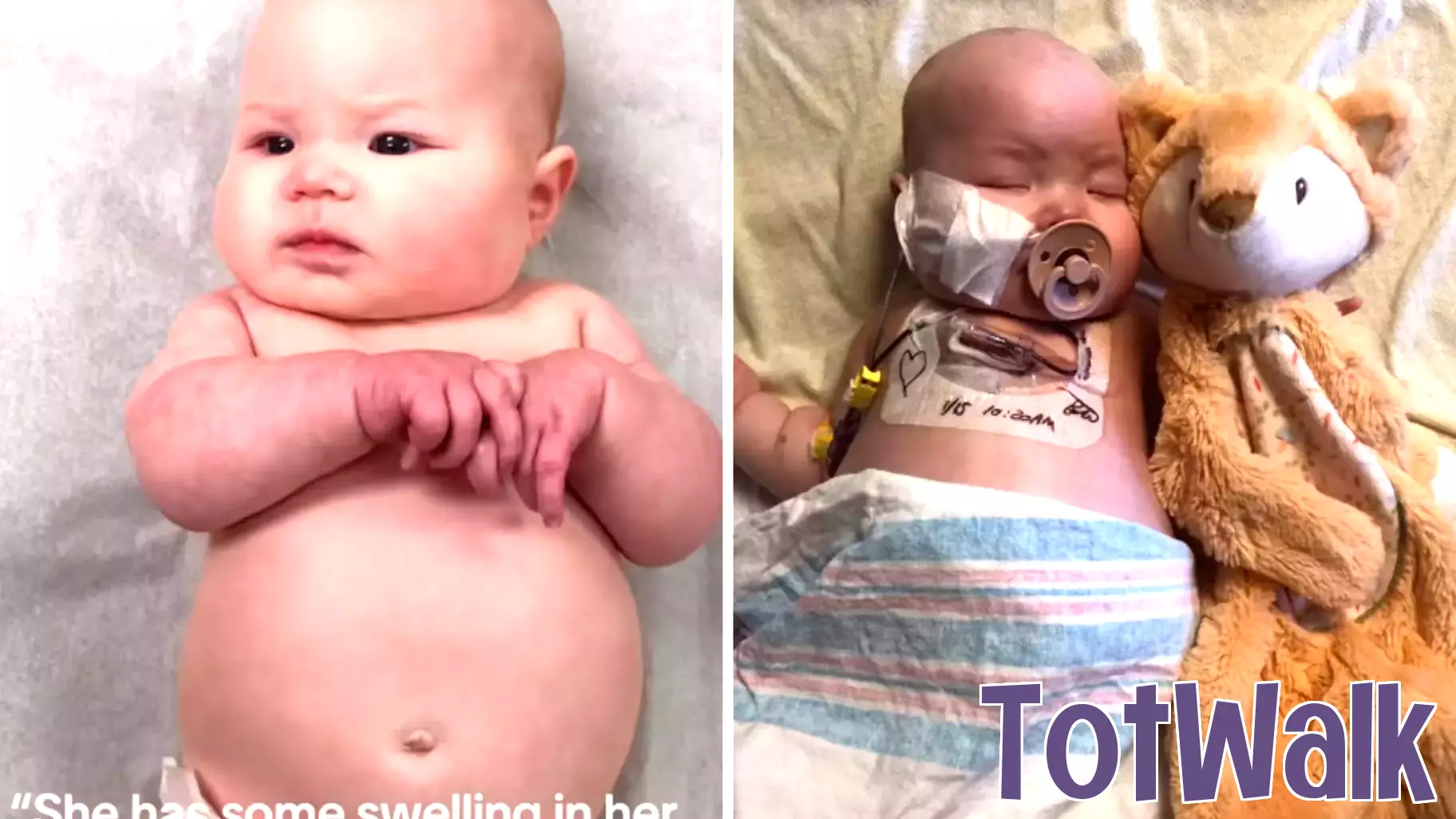 Parents Discover Heartbreaking Cause Behind Baby's Swollen Feet